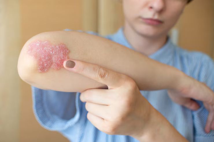 Best Psoriasis treatment in Kochi