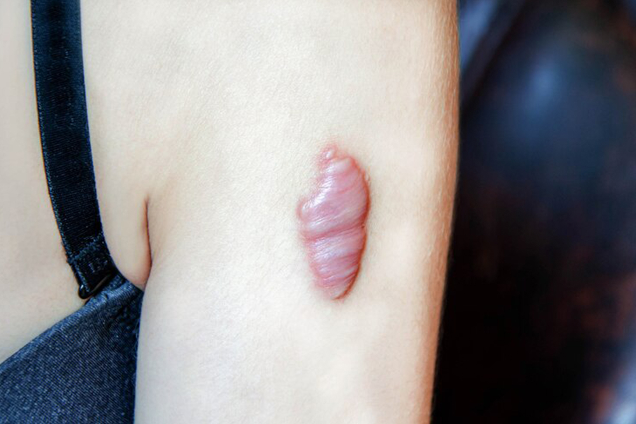 Keloid Treatment in Kochi