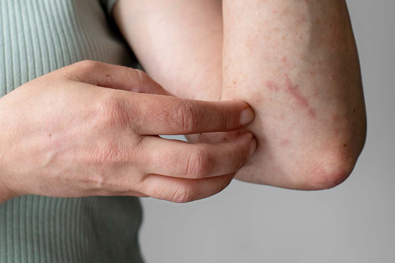 Rashes Treatment in Kochi