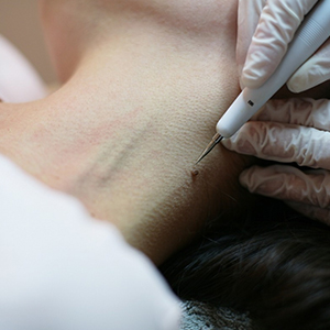 Visible skin improvement after professional skin care treatment in Kochi